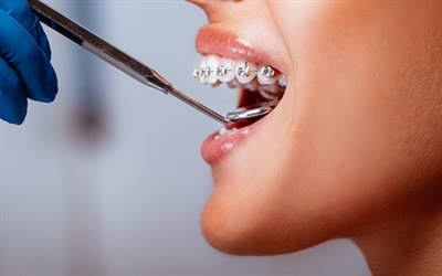치과, 4k, 치아 교정기, 중괄호 확인, 구강학, 사례 개념, 교정 케이스